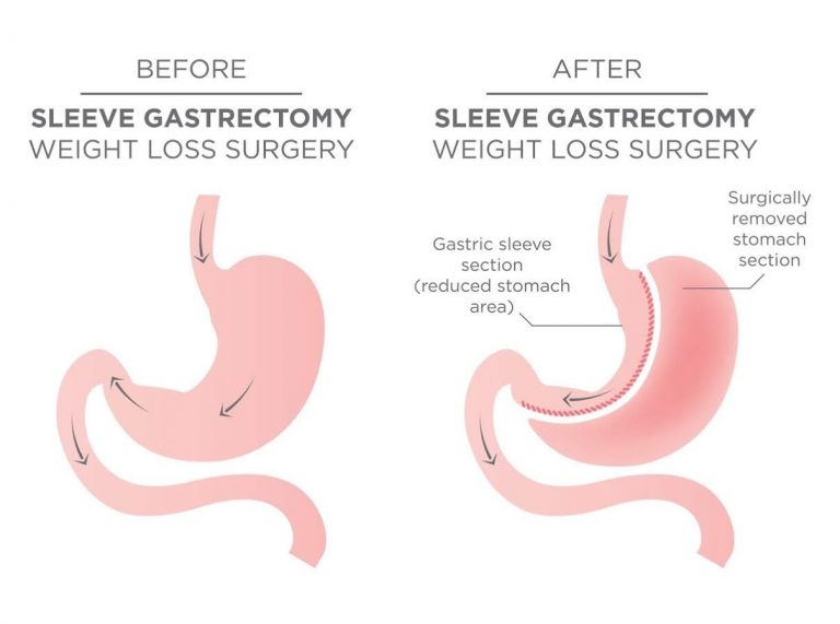 How Can You Speed Up Your Recovery from Gastric Sleeve Surgery?